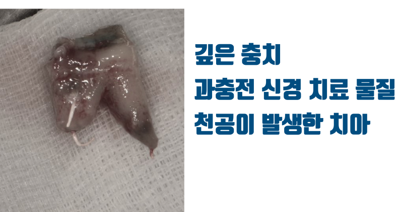 재식술 발치한 치아를 포기하는 경우는 없습니다 무조건 다시 집어넣습니다 #재식술 #치아재식술 #최용훈원장