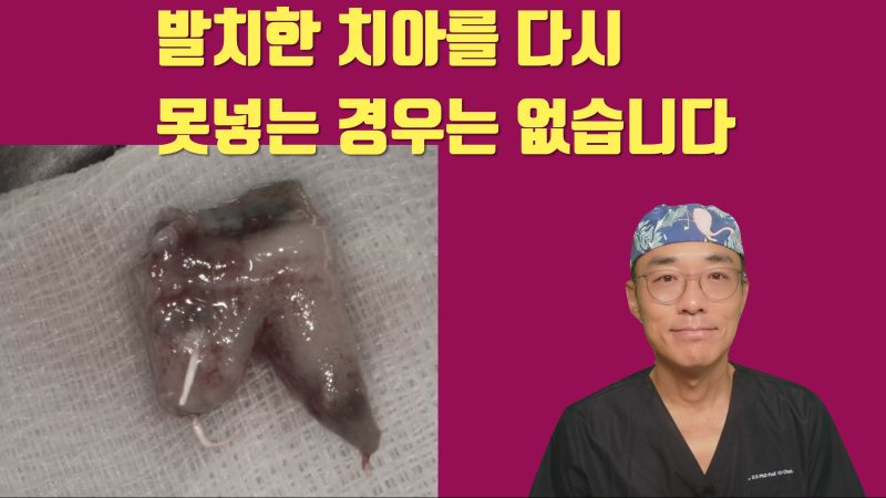 재식술 발치한 치아를 포기하는 경우는 없습니다 무조건 다시 집어넣습니다 #재식술 #치아재식술 #최용훈원장