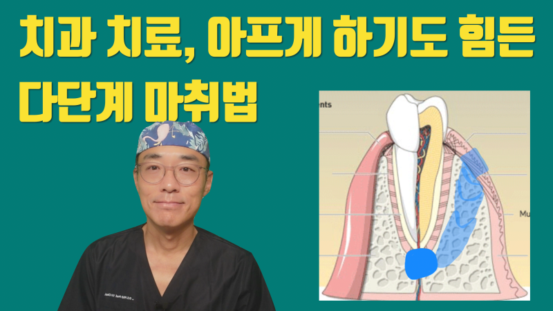 이 이상의 치과 마취는 없다 ! 골내 마취 + 다단계 마취법 #무통마취 #최용훈원장