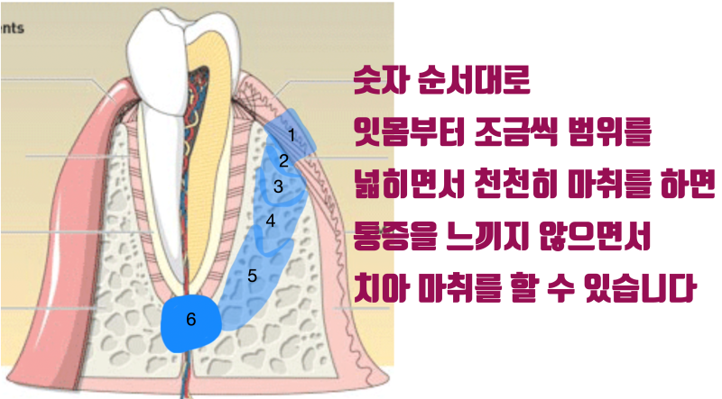 이 이상의 치과 마취는 없다 ! 골내 마취 + 다단계 마취법 #무통마취 #최용훈원장