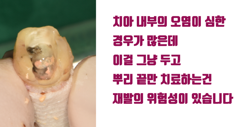 [솔직 고백] 재식술 이렇게 해서 실패했습니다 #재식술 #치아재식술 #최용훈원장 사진 4