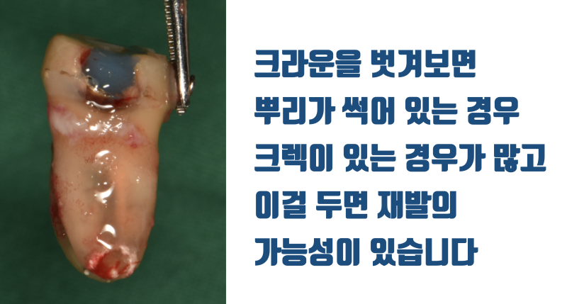 [솔직 고백] 재식술 이렇게 해서 실패했습니다 #재식술 #치아재식술 #최용훈원장