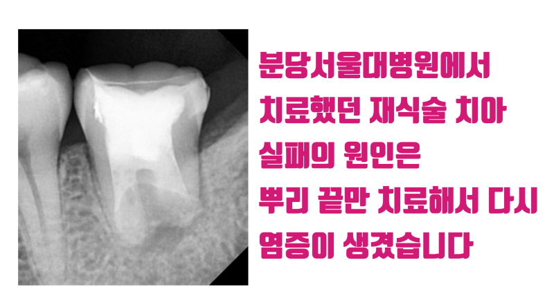 [솔직 고백] 재식술 이렇게 해서 실패했습니다 #재식술 #치아재식술 #최용훈원장 사진 2