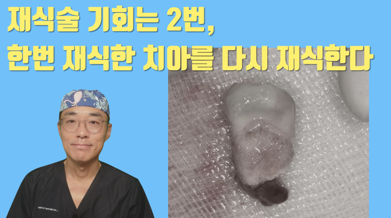 한번도 어려운 재식술을 같은 치아에 두번 하는게 가능한 이유 #재식술 #치아재식술 #의도적재식술