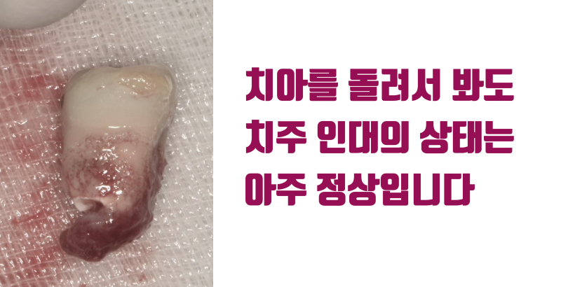 한번도 어려운 재식술을 같은 치아에 두번 하는게 가능한 이유 #재식술 #치아재식술 #의도적재식술 사진 3