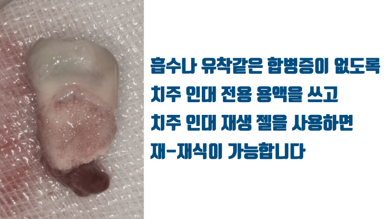 한번도 어려운 재식술을 같은 치아에 두번 하는게 가능한 이유 #재식술 #치아재식술 #의도적재식술