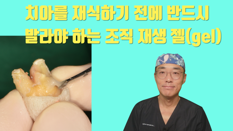 재식술 할 때 치아 표면에 반드시 발라야 하는 젤 #재식술 #치아재식술 #최용훈원장