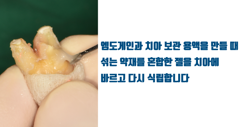 재식술 할 때 치아 표면에 반드시 발라야 하는 젤 #재식술 #치아재식술 #최용훈원장
