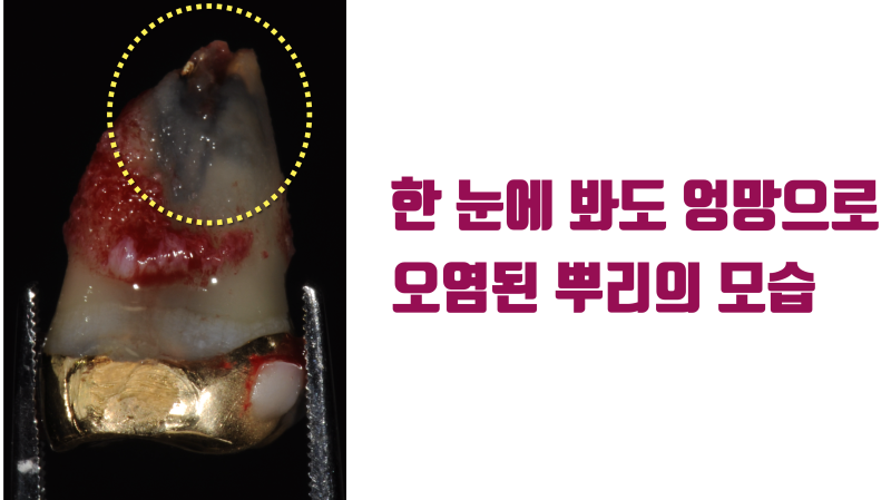 재식술을 해야 볼 수 있고 또 해결할 수 있는 심각한 치아 내부의 모습 #재식술 #치아재식술 #최용훈원장