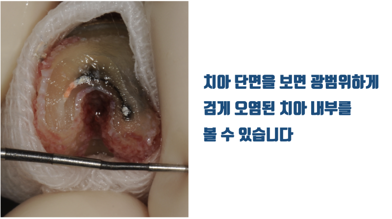 재식술을 해야 볼 수 있고 또 해결할 수 있는 심각한 치아 내부의 모습 #재식술 #치아재식술 #최용훈원장 사진 3