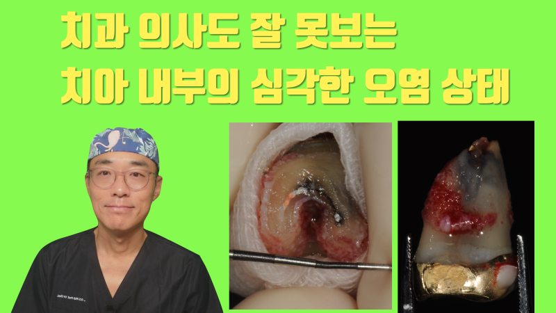 재식술을 해야 볼 수 있고 또 해결할 수 있는 심각한 치아 내부의 모습 #재식술 #치아재식술 #최용훈원장