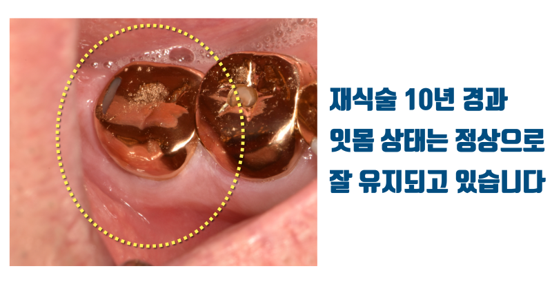 오염 심한 치아 재식술 10년 경과 증례 #재식술 #치아재식술 #최용훈원장 사진 4