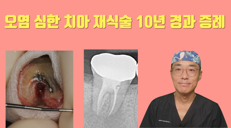 오염 심한 치아 재식술 10년 경과 증례 #재식술 #치아재식술 #최용훈원장