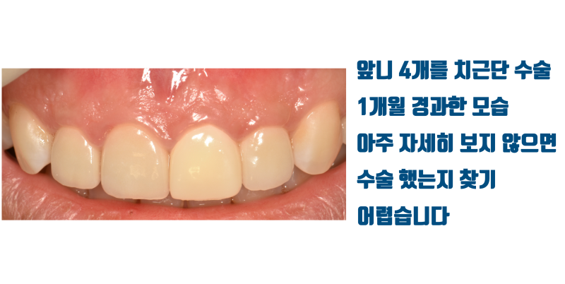 치근단 수술(치근 절제술)은 흔적이 남지 않게 흉터가 남지 않도록 하는게 중요합니다 #치근단수술 #치근절제술 #최용훈원장