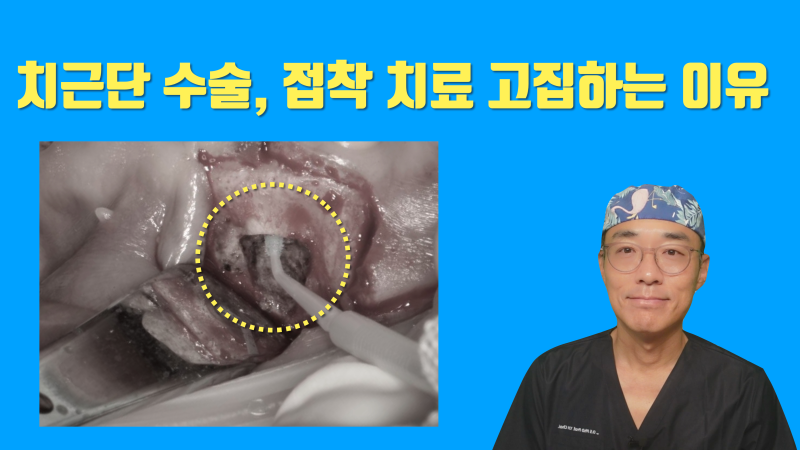 치근단 수술 재발 방지를 위해서 접착 치료를 추천 #치근절제술 #치근단수술 #최용훈원장