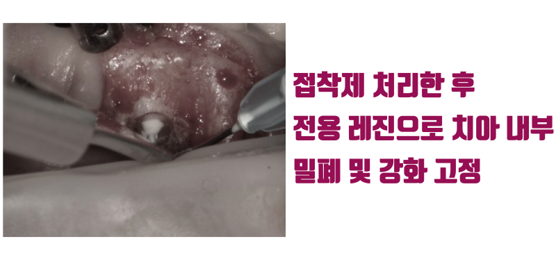 치근단 수술 재발 방지를 위해서 접착 치료를 추천 #치근절제술 #치근단수술 #최용훈원장 사진 3