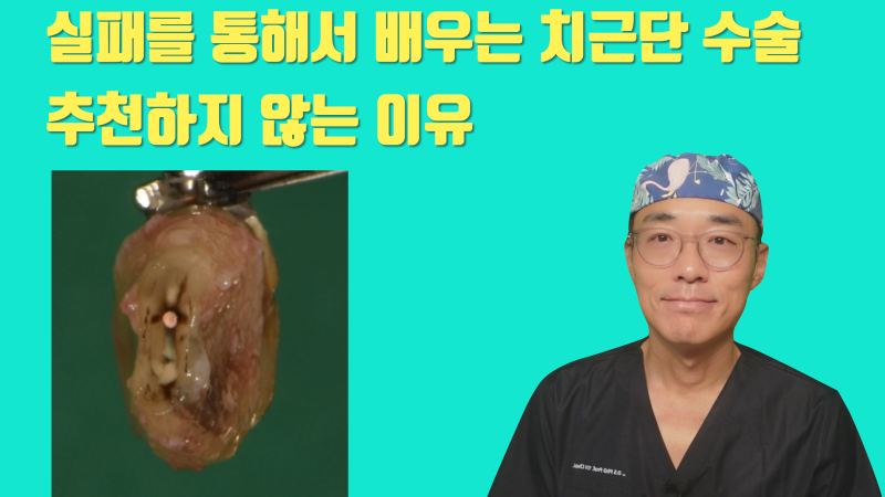 치근 절제술(치근단 수술) 실패한 치아에서 배우는 치근단 수술 추천하지 않는 이유 #치근절제술 #재식술 #최용훈원장