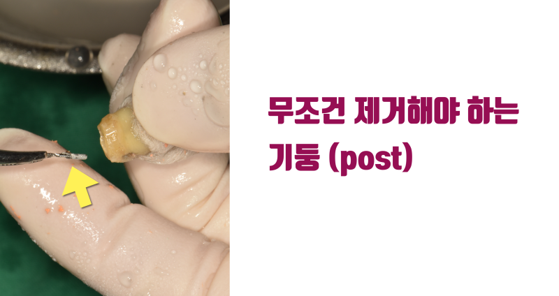 치근 절제술(치근단 수술) 실패한 치아에서 배우는 치근단 수술 추천하지 않는 이유 #치근절제술 #재식술 #최용훈원장 사진 5