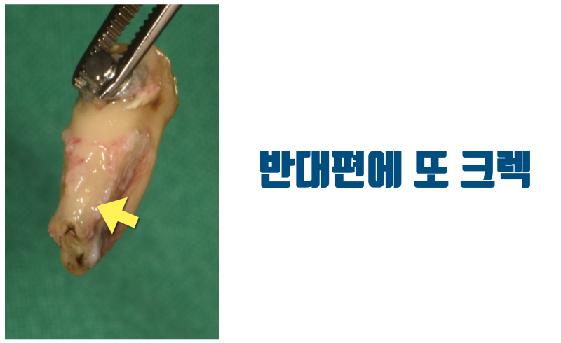 치근 절제술(치근단 수술) 실패한 치아에서 배우는 치근단 수술 추천하지 않는 이유 #치근절제술 #재식술 #최용훈원장 사진 4