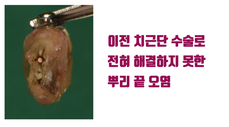 치근 절제술(치근단 수술) 실패한 치아에서 배우는 치근단 수술 추천하지 않는 이유 #치근절제술 #재식술 #최용훈원장 사진 3