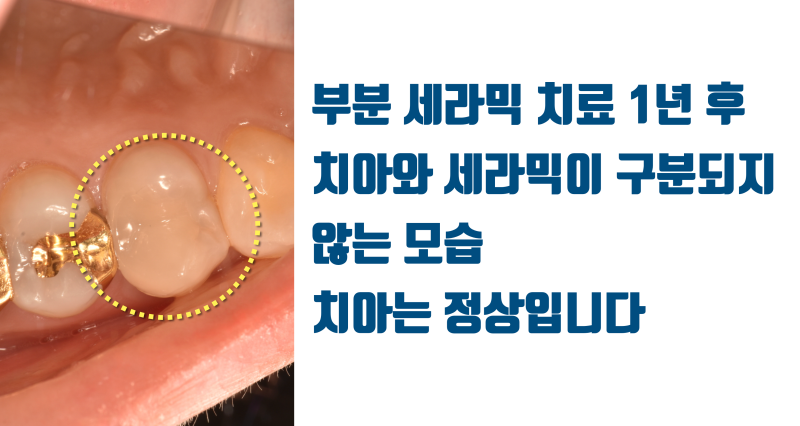 [소신 진료] 깊은 충치를 신경 치료, 크라운 하지 않은 경우 1년 경과 #접착세라믹 #치아살리기 #최용훈원장 사진 4