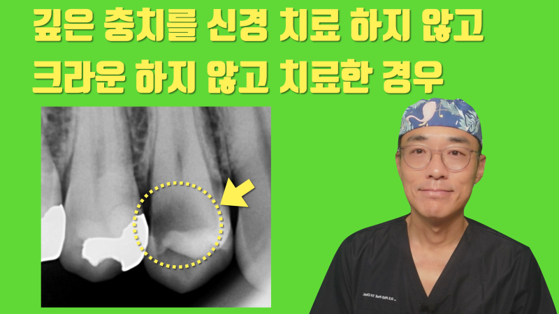 [소신 진료] 깊은 충치를 신경 치료, 크라운 하지 않은 경우 1년 경과 #접착세라믹 #치아살리기 #최용훈원장