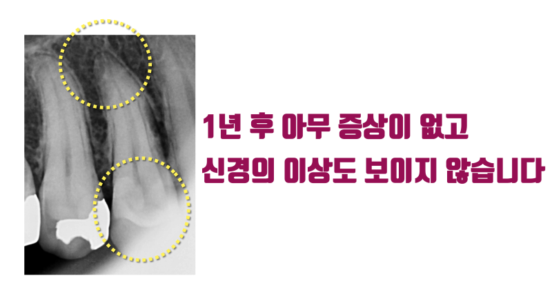 [소신 진료] 깊은 충치를 신경 치료, 크라운 하지 않은 경우 1년 경과 #접착세라믹 #치아살리기 #최용훈원장