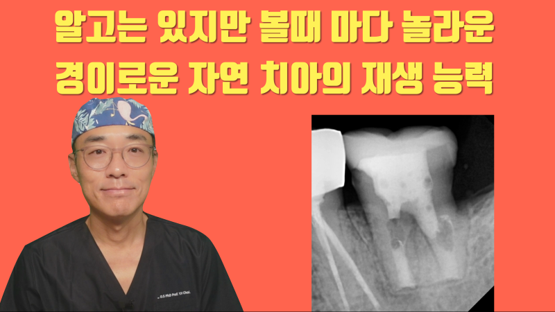 재식술 자연 치아의 놀라운 치조골 재생 능력 #치아재식술 #의도적재식술 #재식술