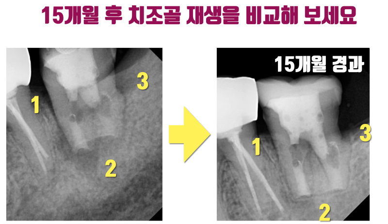 재식술 자연 치아의 놀라운 치조골 재생 능력 #치아재식술 #의도적재식술 #재식술