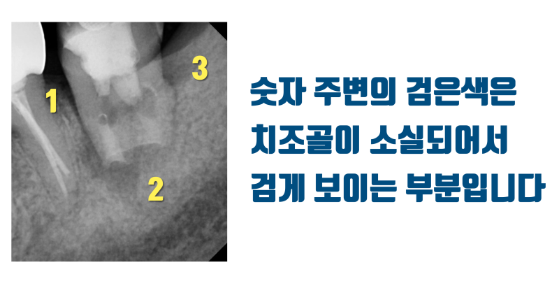 재식술 자연 치아의 놀라운 치조골 재생 능력 #치아재식술 #의도적재식술 #재식술 사진 2