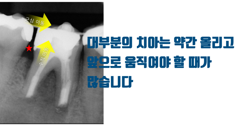 [재식술의 가장 큰 가치] 치아의 최적의 위치를 다시 찾아 줄 수 있다 ! #재식술 #치아재식술 #최용훈원장 사진 4