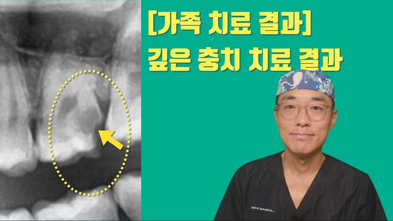 [가족의 충치 치료] 깊은 충치 신경 치료 없이 치료한 결과 #접착세라믹 #치아살리기 #최용훈원장