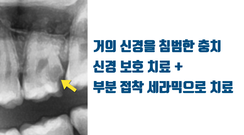 [가족의 충치 치료] 깊은 충치 신경 치료 없이 치료한 결과 #접착세라믹 #치아살리기 #최용훈원장