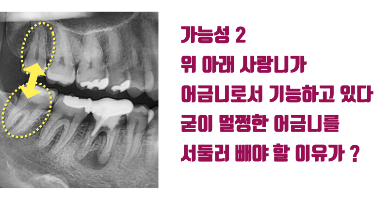 [외로운 외침] 멀쩡한 사랑니는 유지하라고 권유하는 이유 #재식술 #치아이식 #최용훈원장
