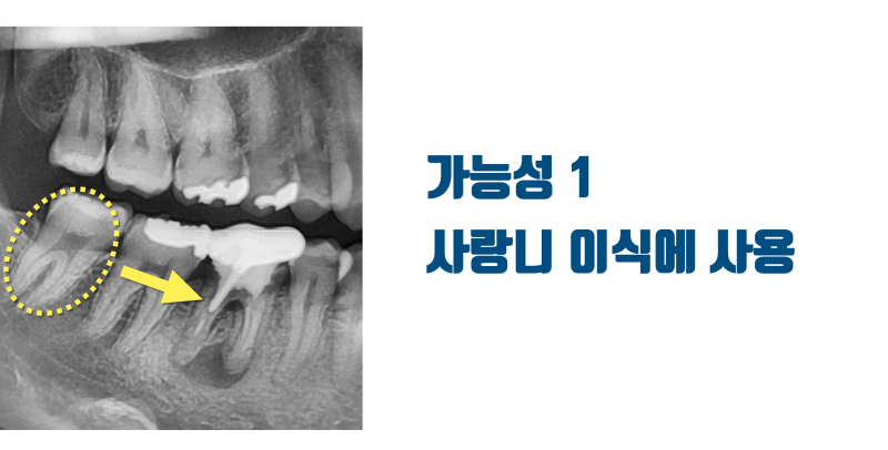 [외로운 외침] 멀쩡한 사랑니는 유지하라고 권유하는 이유 #재식술 #치아이식 #최용훈원장 사진 2