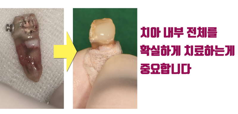 [재식술 성공의 조건] 크라운은 벗기고 재식술을 하는게 좋은 이유 #재식술 #치아재식술 #최용훈원장 사진 3