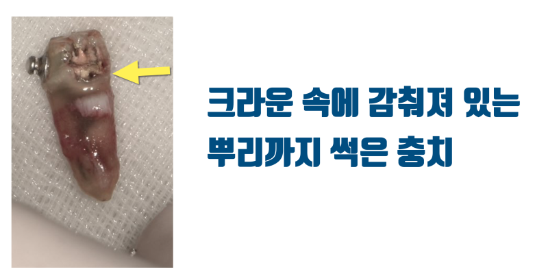 [재식술 성공의 조건] 크라운은 벗기고 재식술을 하는게 좋은 이유 #재식술 #치아재식술 #최용훈원장