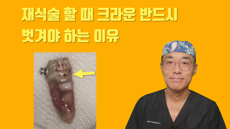 [재식술 성공의 조건] 크라운은 벗기고 재식술을 하는게 좋은 이유 #재식술 #치아재식술 #최용훈원장