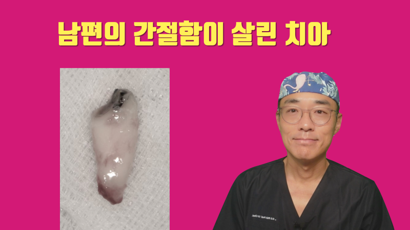 [감동이 있는 재식술] 내 치아 살린 것처럼 아내 치아도 살려주세요 #재식술 #치아재식술 #최용훈원장
