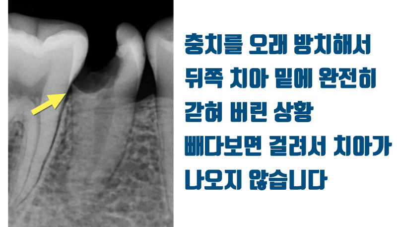 [감동이 있는 재식술] 내 치아 살린 것처럼 아내 치아도 살려주세요 #재식술 #치아재식술 #최용훈원장