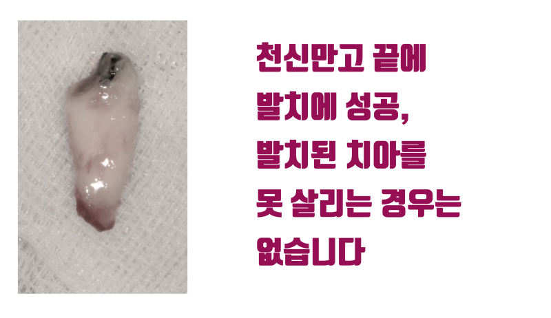 [감동이 있는 재식술] 내 치아 살린 것처럼 아내 치아도 살려주세요 #재식술 #치아재식술 #최용훈원장 사진 3