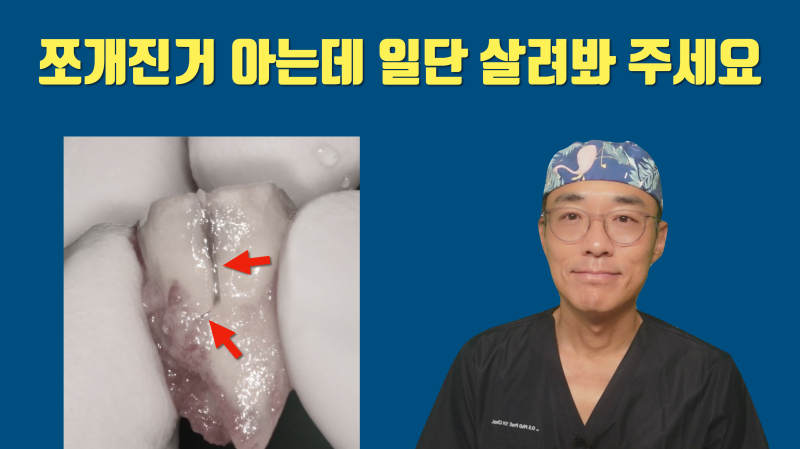 [포기한 치아 살리기] 완전 파절치 접착 재식술 #치아재식술 #최용훈원장