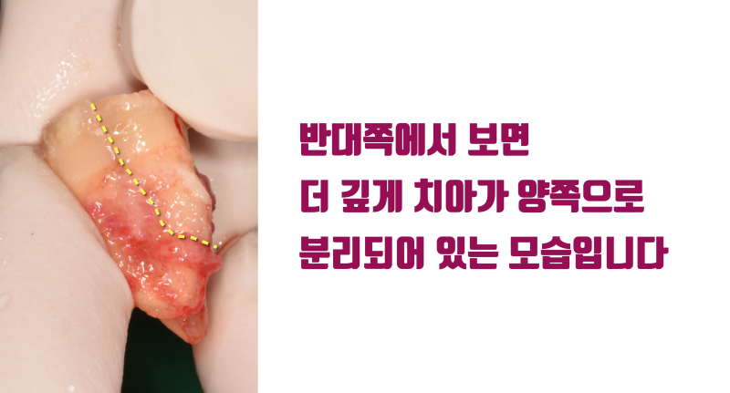 [포기한 치아 살리기] 완전 파절치 접착 재식술 #치아재식술 #최용훈원장 사진 3