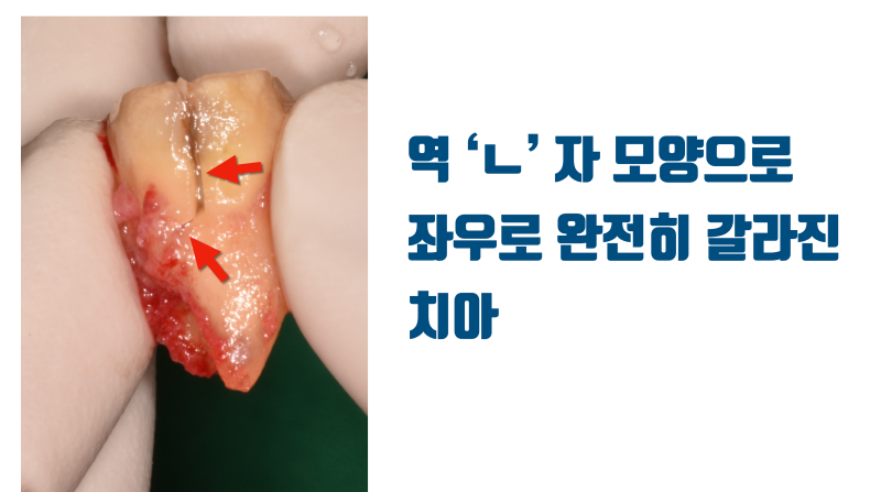 [포기한 치아 살리기] 완전 파절치 접착 재식술 #치아재식술 #최용훈원장