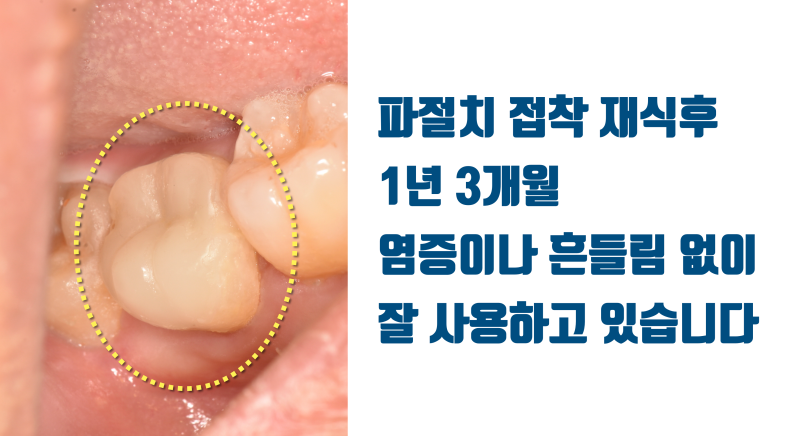 [포기한 치아 살리기] 완전 파절치 접착 재식술 #치아재식술 #최용훈원장 사진 4