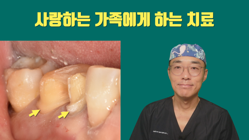 [가족 치료 후기] 사랑하는 가족에게 하는 치료 #치아살리기 #최용훈원장