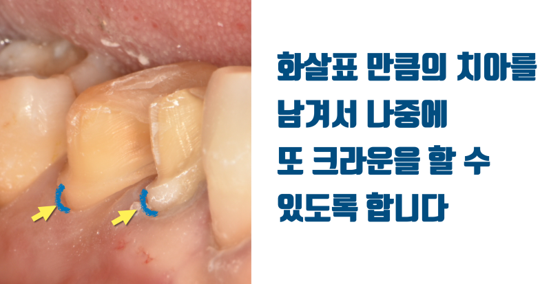 [가족 치료 후기] 사랑하는 가족에게 하는 치료 #치아살리기 #최용훈원장