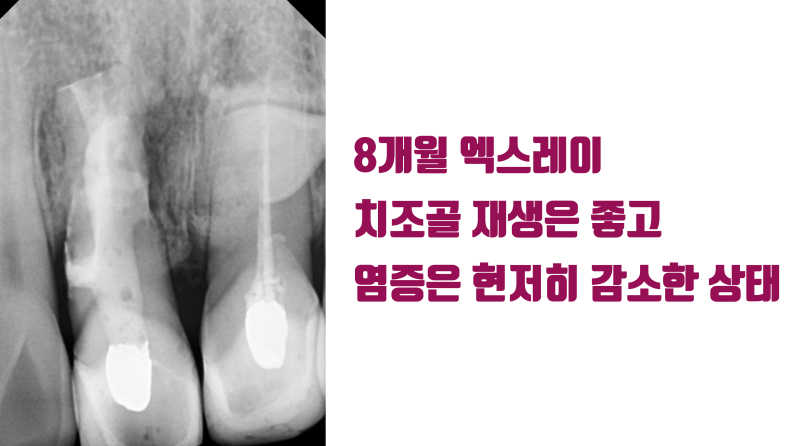 [불가능한 치아를 살린다] 산산 조각난 치아를 살려달라는 환자의 간절함이 살린 재식술 #재식술 #치아재식술 #최용훈원장