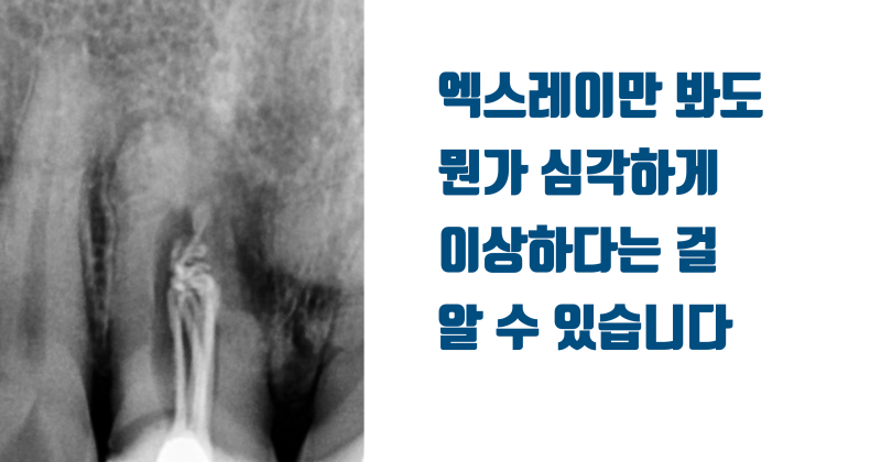 [불가능한 치아를 살린다] 산산 조각난 치아를 살려달라는 환자의 간절함이 살린 재식술 #재식술 #치아재식술 #최용훈원장 사진 2