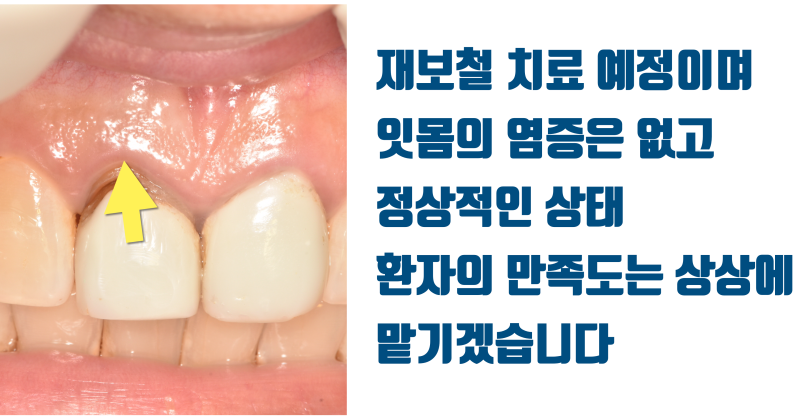 [불가능한 치아를 살린다] 산산 조각난 치아를 살려달라는 환자의 간절함이 살린 재식술 #재식술 #치아재식술 #최용훈원장 사진 7